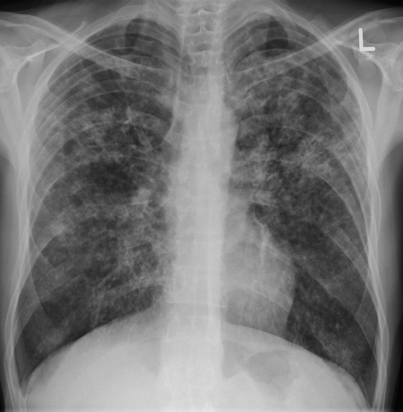 Fibrosis Pulmonar: causas, síntomas y más | Blog MAPFRE asthma diagram 